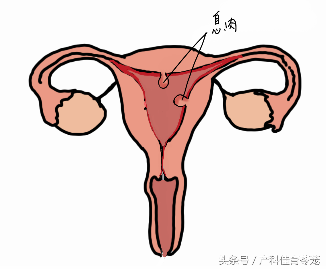 北京供卵代生男孩中心_子宫内膜息肉，也会导致不孕哦
