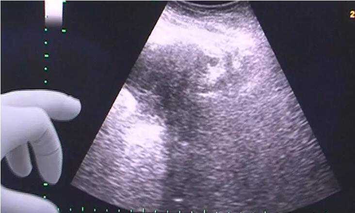 北京供卵代母_助孕做试管婴儿期间为什么要频繁的做B超检查